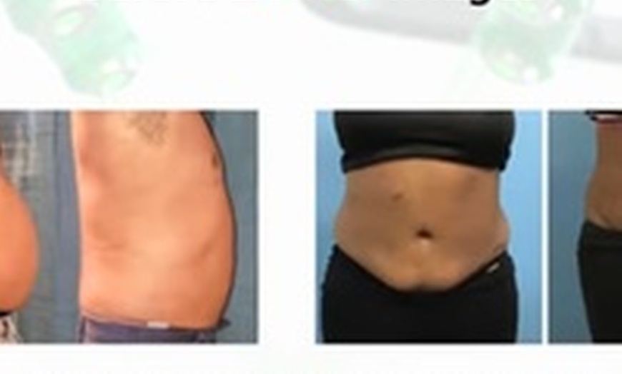 Image 2: Emerald Laser Fat Loss - Up To 4 inches Loss