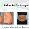 Image 2: Emerald Laser Fat Loss - Up To 4 inches Loss