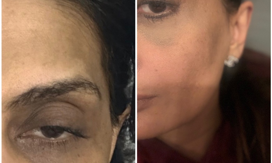 Image 3: Under-Eye Polynucleotides or PROFHILO® Full-Face Treatment Packages