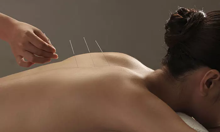 One or Three Acupuncture Sessions with Relief Therapy at ABC Bodyworks (Up to 75% Off) - Primary Image