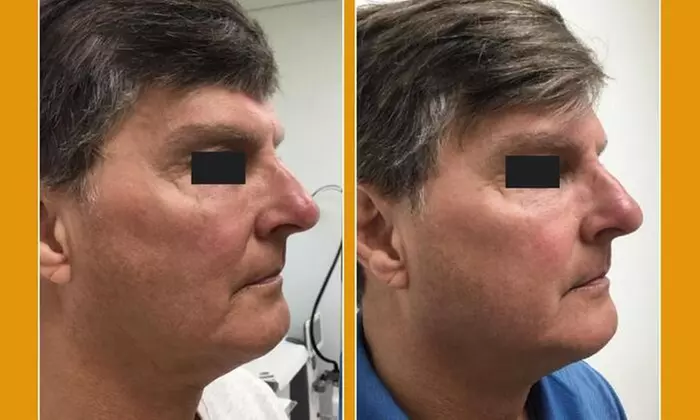 Ultherapy Prime Treatment with options for Face, Neck and Chest