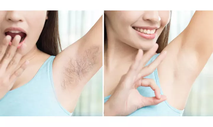One or Two 30-Minute Electrolysis Hair Removal Sessions