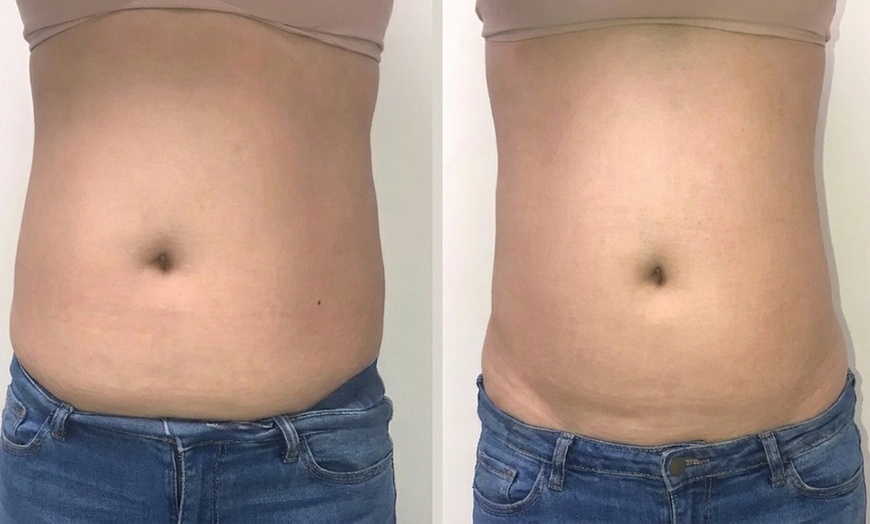 Image 2: Transform with Four, Six, Eight or Ten Laser Lipo Treatments 