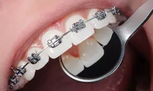 Ortodoncia con brackets y 3 revisiones sin cargo estudio completo u opción de escaneo 3D con diseño  de sonrisa digital