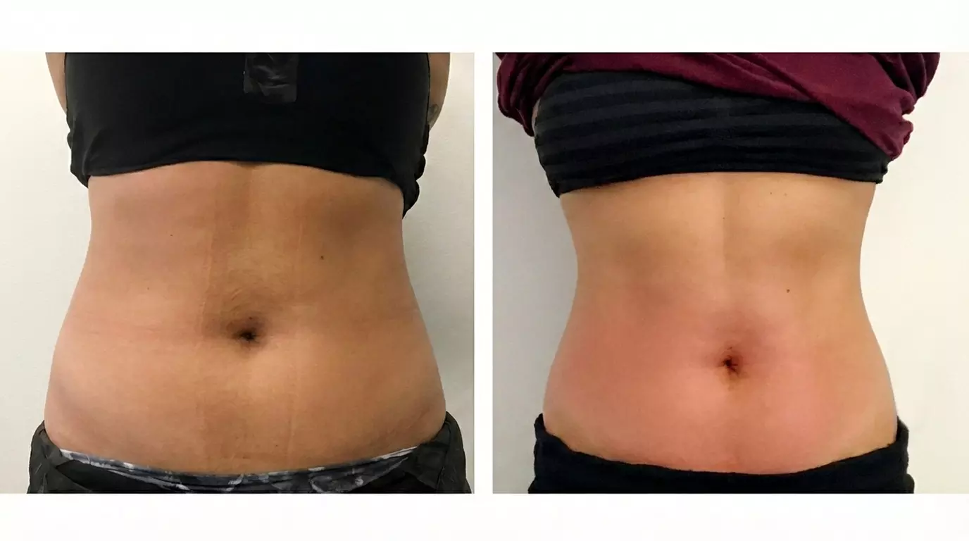 One or Three Fat Reduction Treatments with Venus Bliss Max