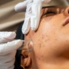 Image 4: Up to 47% Off on Facial - HydraFacial at Empress Skin Bromsgrove
