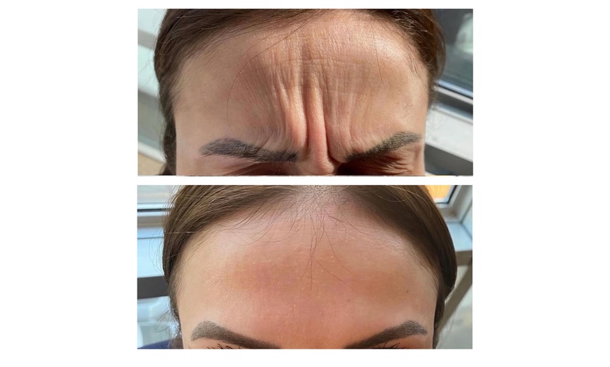 Image 3: Up to 47% Off Botox and Juvéderm at AK Medical Spa