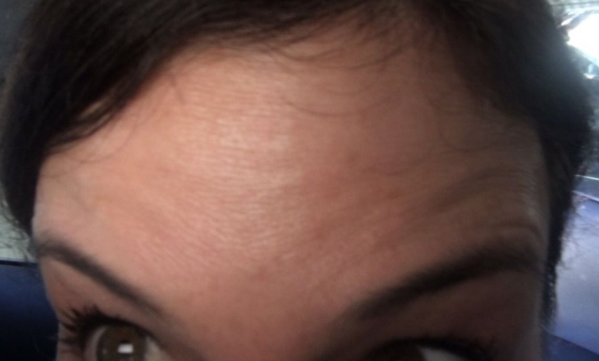 Image 4: Up to 40% Off Botox at Botox and Beauty Boutiques