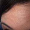 Image 4: Up to 40% Off Botox at Botox and Beauty Boutiques