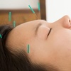 Image 4: Relieve with One, Two or Three 60 Min Choice of Acupuncture Sessions