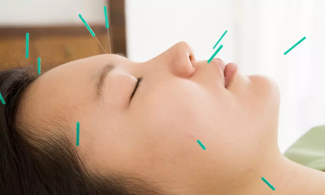 Relieve with One, Two or Three 60 Min Choice of Acupuncture Sessions