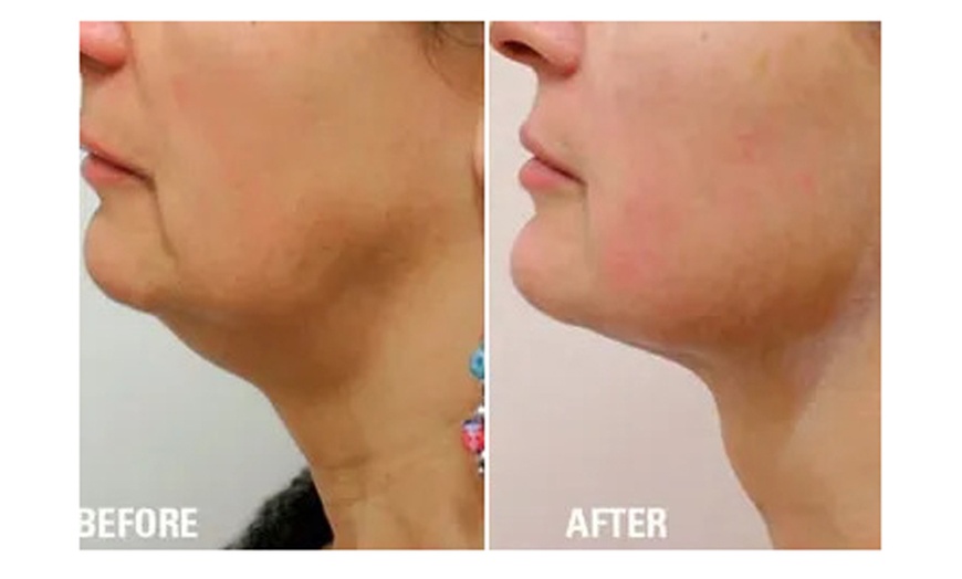 Image 5: 1 HIFU Non-Surgical Lift (Double Chin, Jawline and Chin, or Full Face)