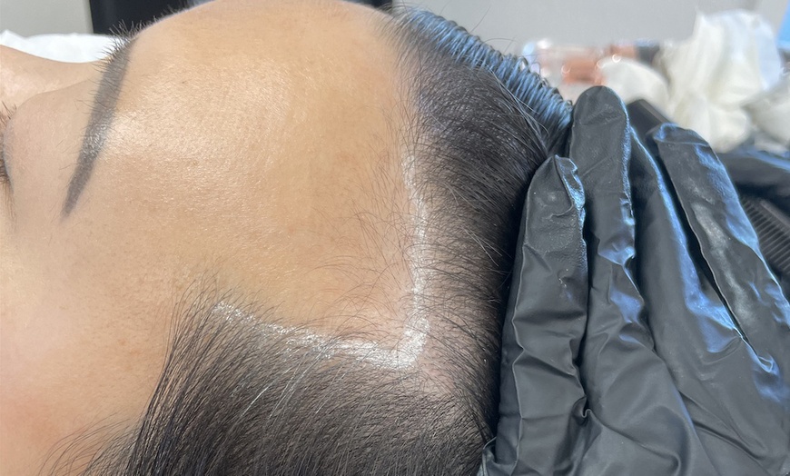 Image 1: Restore Hair Density With Partial Scalp Treatment
