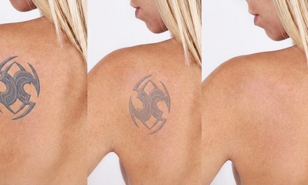 One Laser Tattoo Removal Session on an Extra Small Area - Maximum 1 Sq Inch - Ellis Esthetics