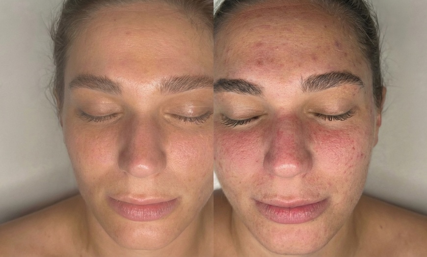 Image 4: Revitalize with One, Three, or Six Sessions of Micro-needling