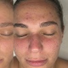 Image 4: Revitalize with One, Three, or Six Sessions of Micro-needling