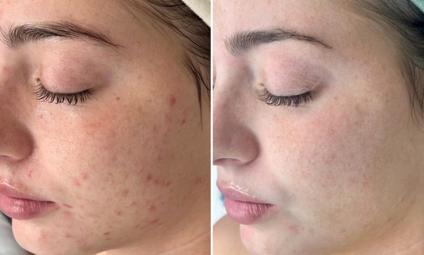 Image 2: Up to 55% Off on Facial - Chosen by Customer at Rise Skin Spa