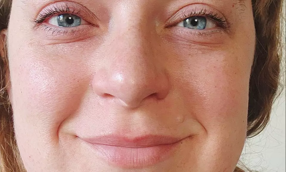 Transform With Laser Resurfacing Or Morpheus Microneedling With PRP