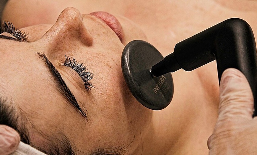 Image 10: 1, 2 o 4 sesiones de radiofrecuencia facial