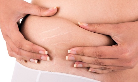 Up to 70% Off Stretch Mark Treatment at The Wellness Body and Spa