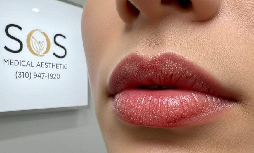 Image 3: Lip Laser Rejuvenation with/wihtout Hyaluronic Acid Filler Options