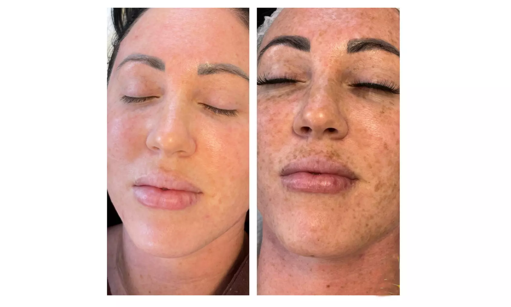 IPL Photofacial Treatments at Tiam Spa Laser And Skin Center, up to 60% Off - Second Medium