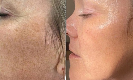 One Laser Facial for Active Acne - THE MBAR MEDSPA