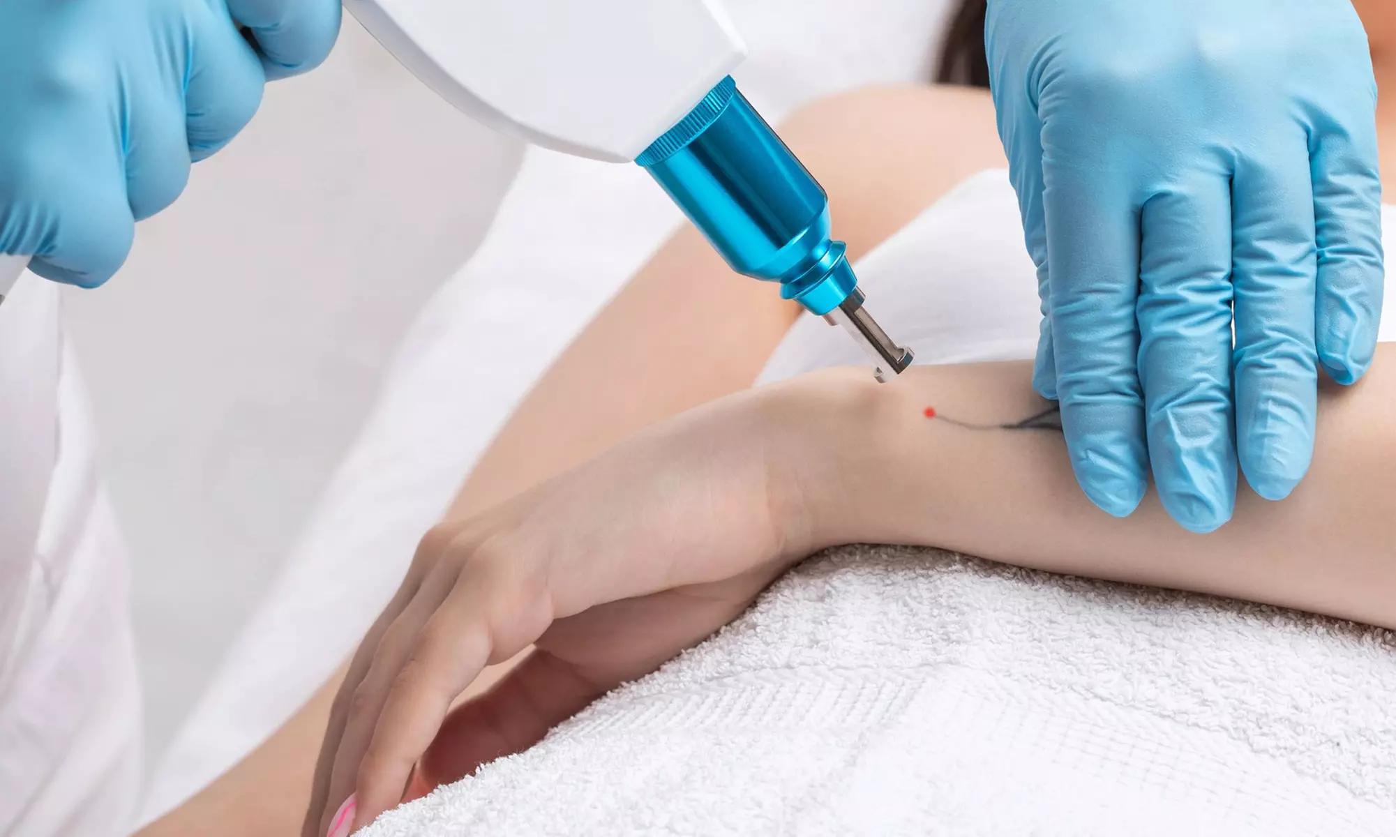 One or Three Laser Tattoo Removal for Small, Medium or Large Areas