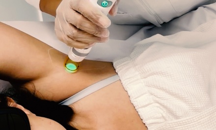 Six Laser Candela GentleMax Pro Plus Hair-Removal Sessions on One Small Area - SILKAWAY
