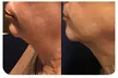 Radio Frequency Skin Tightening Neck Lift – 1, 2, or 3 Sessions at Up to 80% Off for a Firmer, Lifted Look - Second Medium