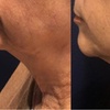 Image 2: Smooth Fine Lines with Non-Invasive Radio Frequency Skin Tightening