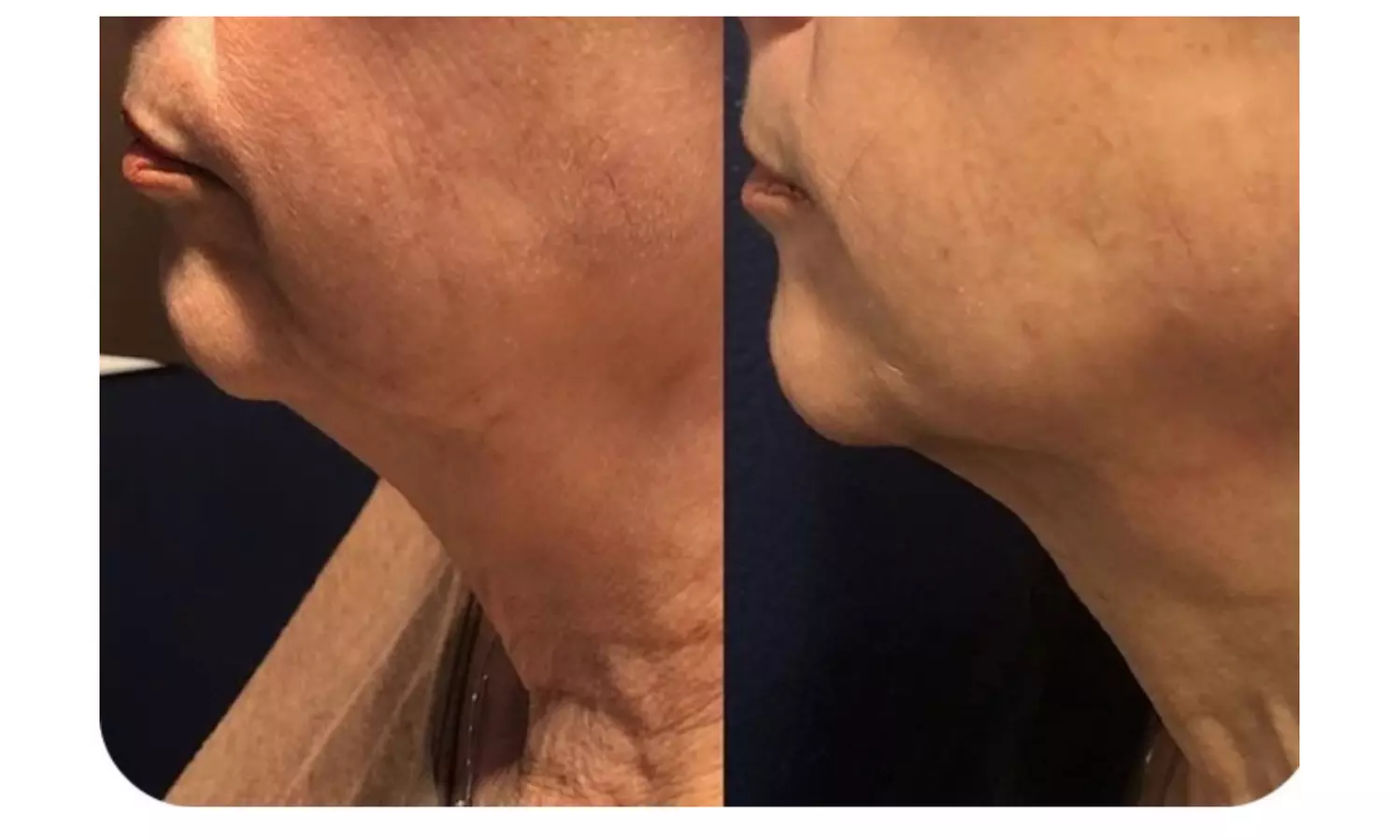 Smooth Fine Lines with Non-Invasive Radio Frequency Skin Tightening