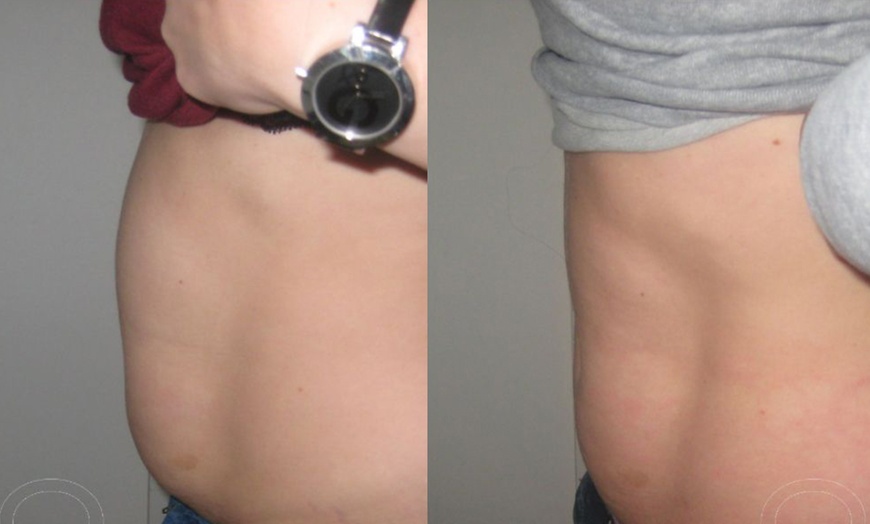 Image 4: Up to 73% Off on Ultrasonic Fat Reduction at LAMURE Aesthetic Clinic