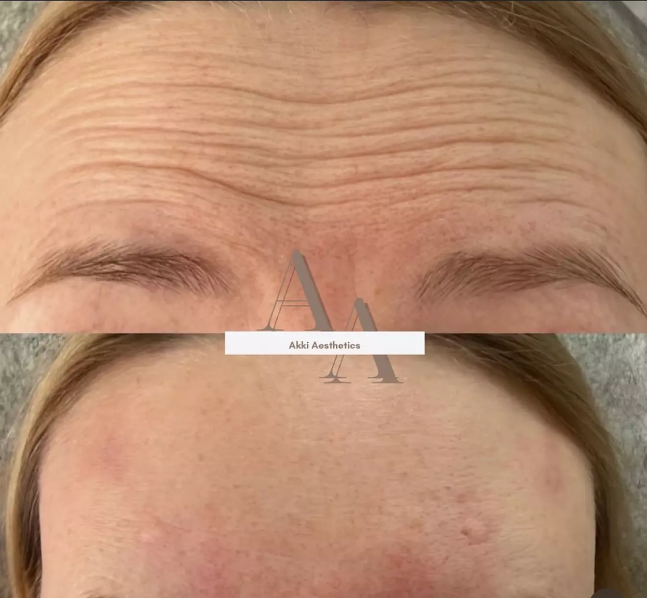 Enhance Your Look with 20, 40, or 60 Units of Botox