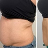 Image 2: Up to 55% Off on Fat Reduction - Non-Branded at Body Radiance Med Spa