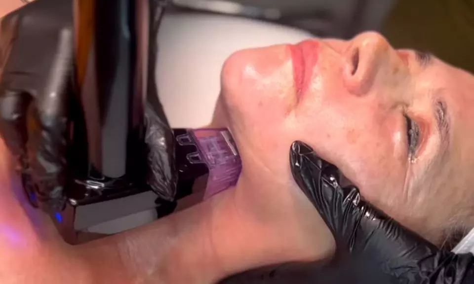 One or Two Morpheus 8 For Full-Face & Neck, Abdomen or Butt