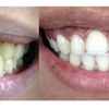 Image 1: LED Teeth Whitening Sessions for a Brighter Smile
