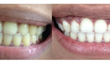 30 Minute LED Teeth Whitening Session (35% Carbamide Peroxide) - Body Ethics Spa