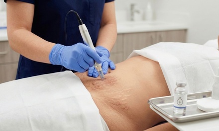 Inkless Stretch Mark Revision Treatment (Small Area) - Rejuvenate U ''IV Therapy and Aesthetics''