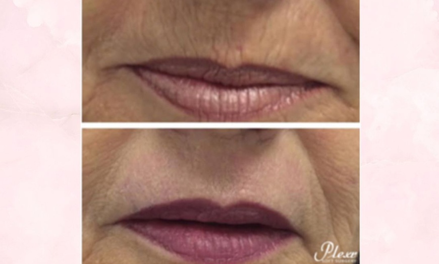 Image 5: PlexR: huidverstrakking zonder snijden