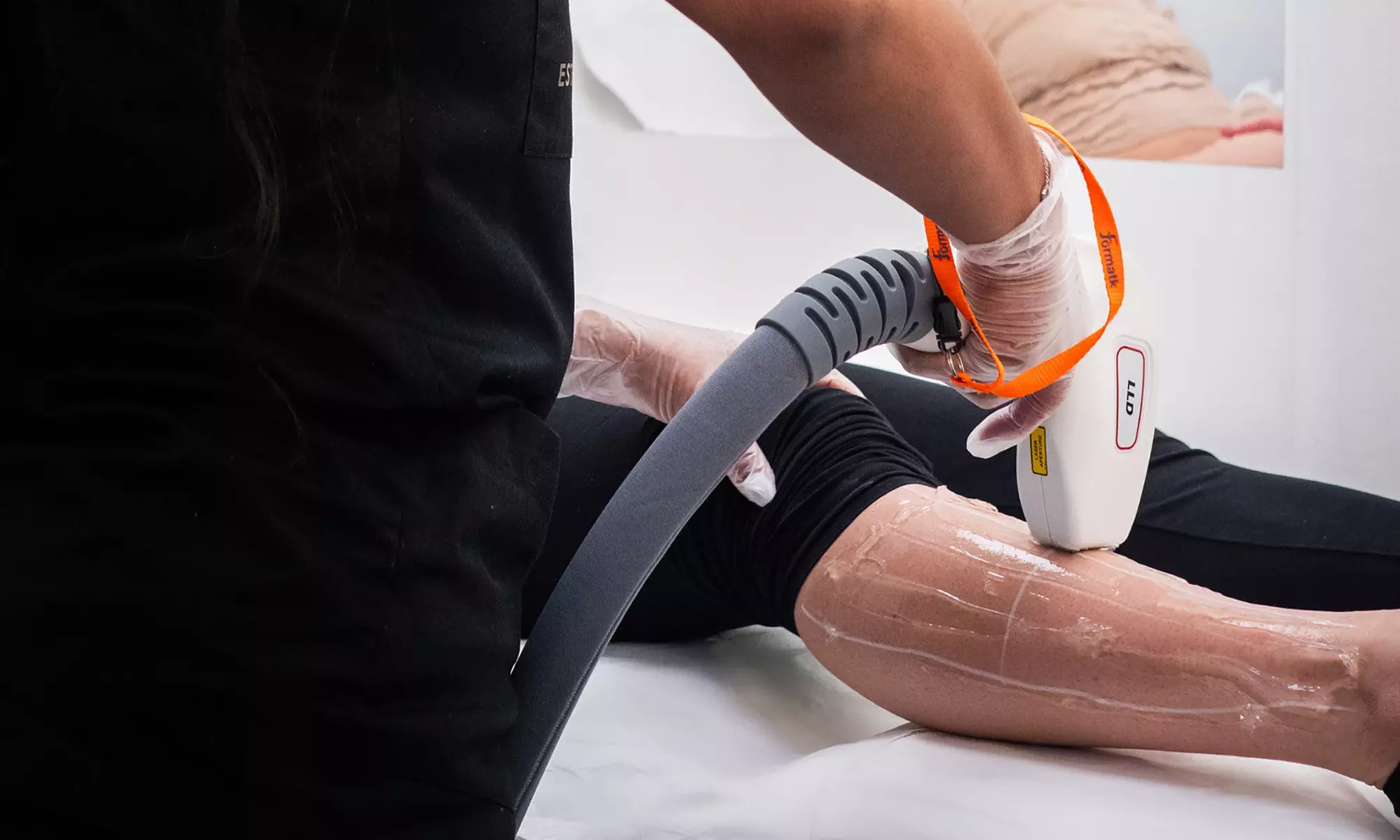 1 ou 2 séances de cryolipolyse de 45 à 60 min sur 1 ou 2 zones