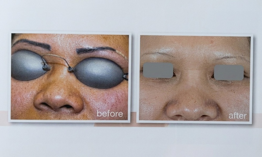 Image 4: 3 Laser Tattoo Removal Sessions: Small, Medium, Large or XL Areas