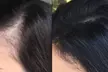 Restore Confidence with Up to 48% Off Scalp Micropigmentation at Rose Beauty Bar - Second Medium