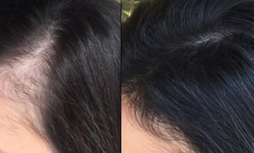 Image 2: Restore Confidence with Scalp Micropigmentation at Rose Beauty Bar