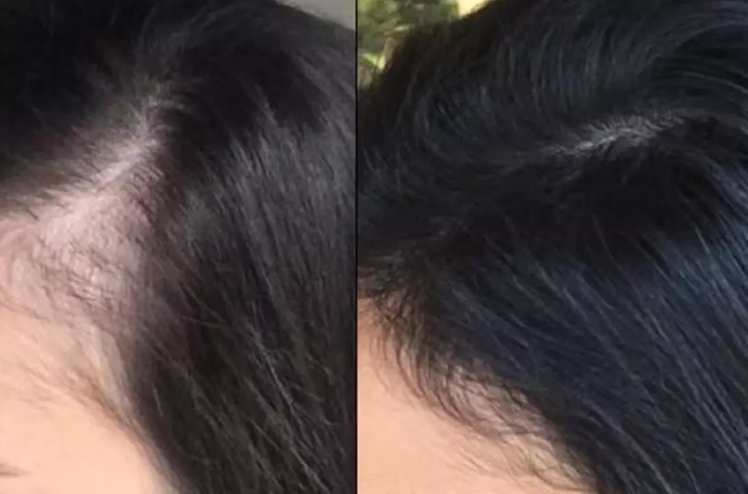 Restore Confidence with Up to 48% Off Scalp Micropigmentation at Rose Beauty Bar