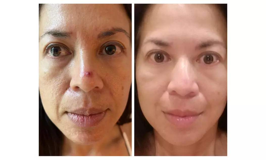 Revitalize with One, Two or Three PRP Hair Restoration Treatments