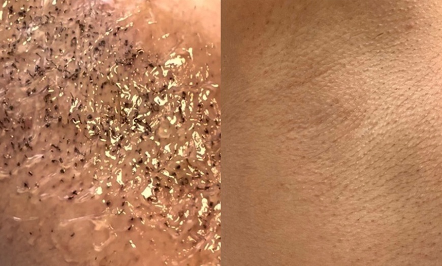 Image 3: Diodenlaser-Haarentfernung an verschiedenen Zonen für 1 Person