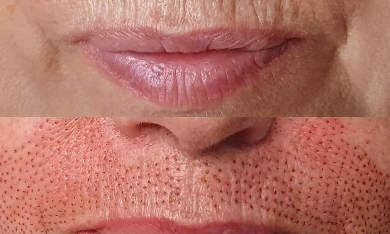 1 o 2 sesiones de plasma pen en zona a elegir para 1 persona