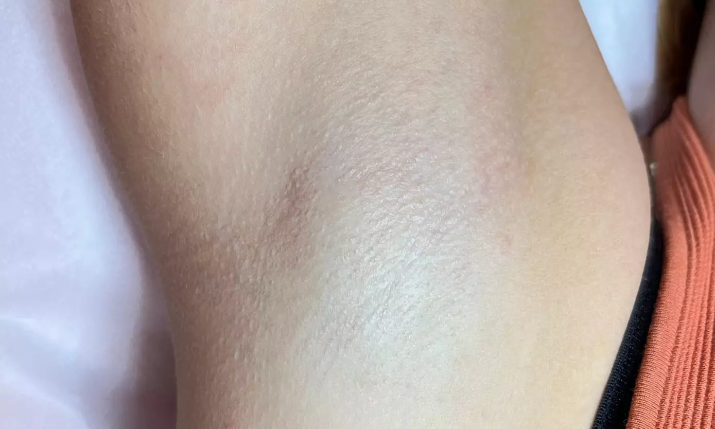 Depilacja laserowa wybranych partii lub całego ciała kobiet i mężczyzn