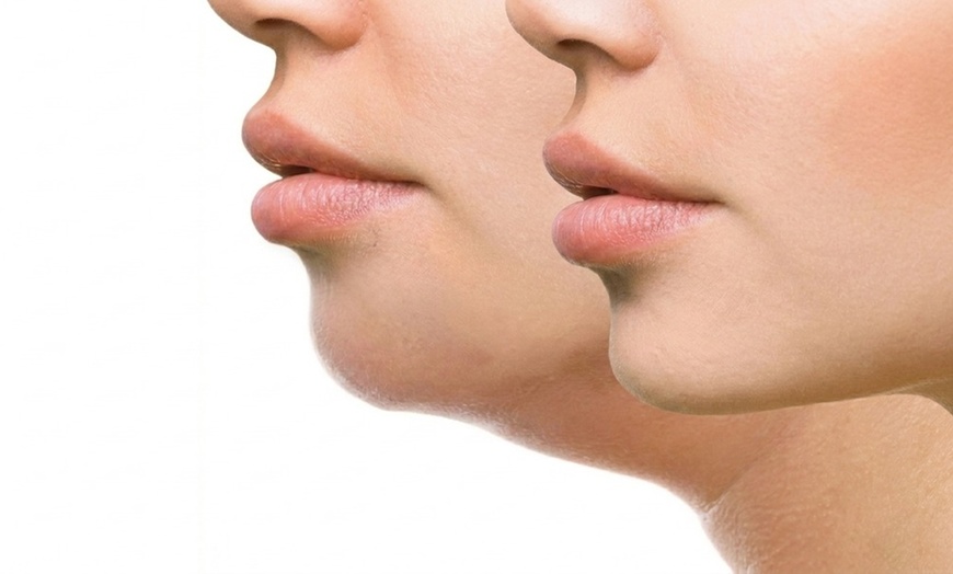 Image 3: Radio Frequency Skin Tightening & EMS Facials | WaxLand 